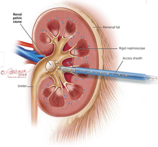 Percutaneous Nephrolithotomy (PCNL)