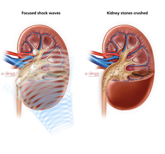 Shock Wave Lithotripsy